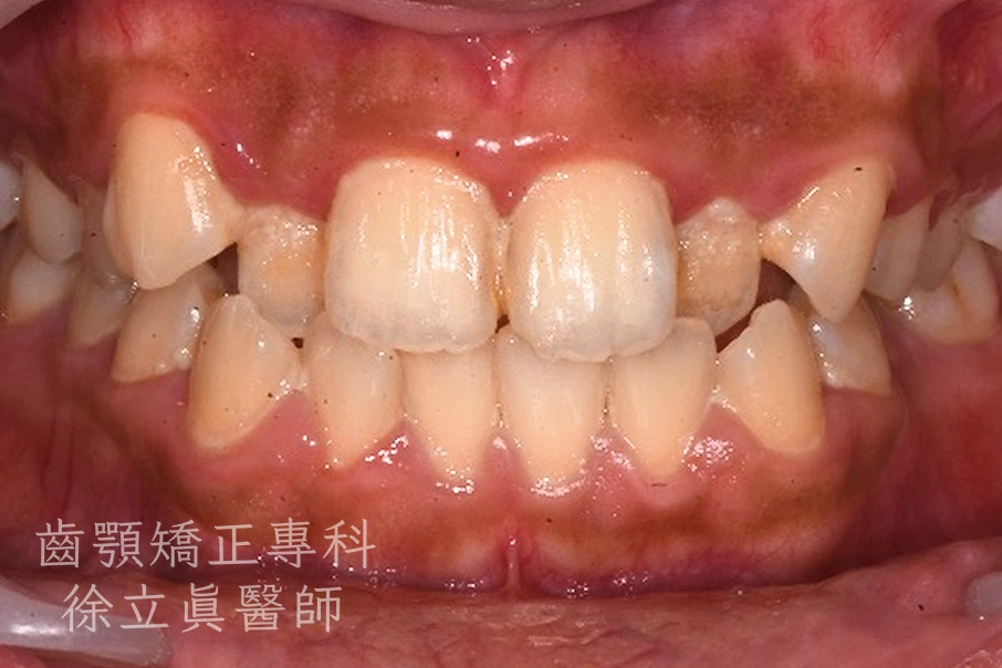 案例一・正面・治療前