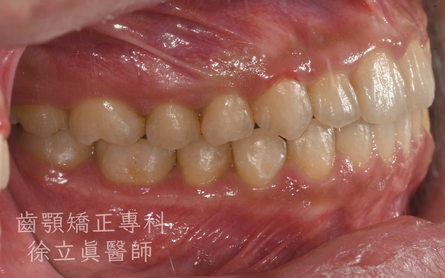 案例一・側面一・治療後