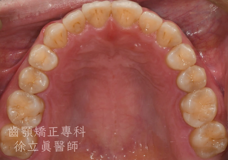 案例一・上顎・治療後