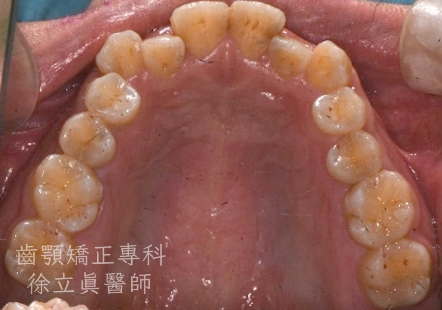案例一・上顎・治療前