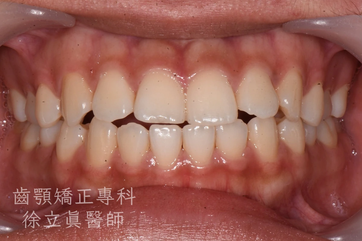 案例二・正面・治療前
