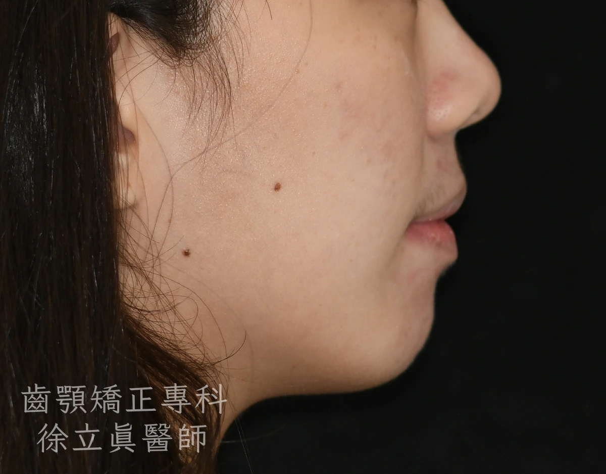案例二・側貌・治療後