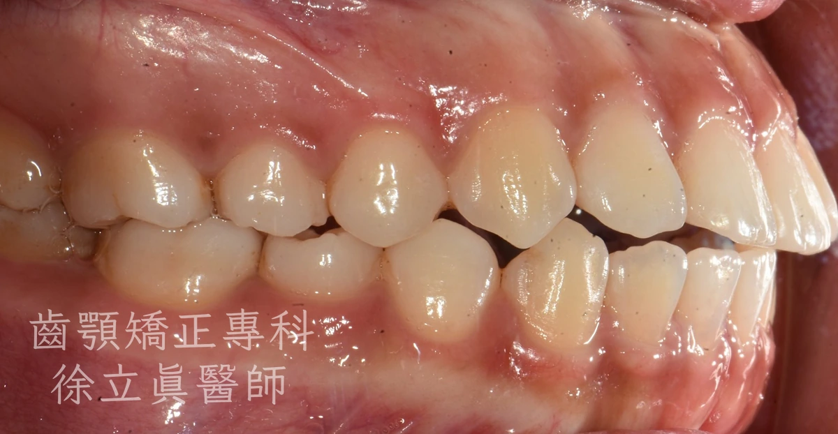 案例二・側面一・治療前