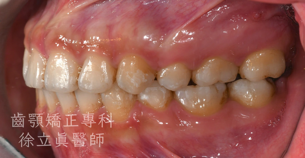 案例二・側面二・治療後