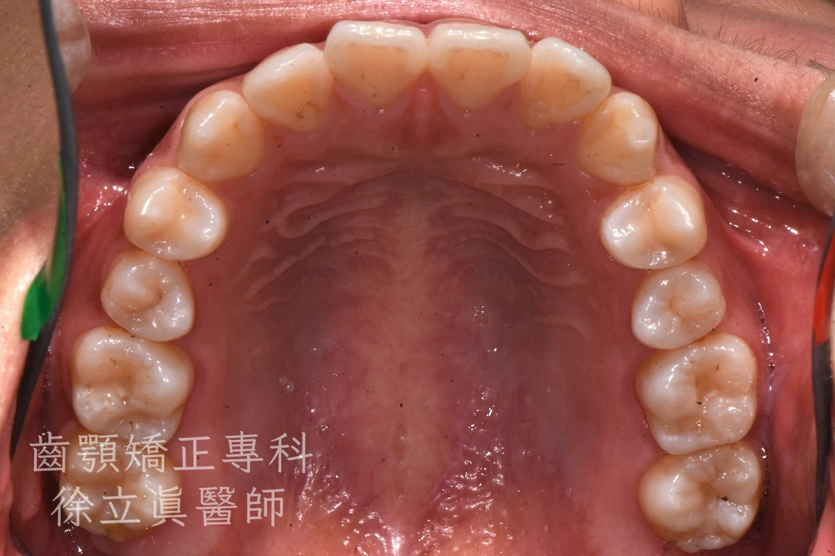 案例二・上顎・治療前