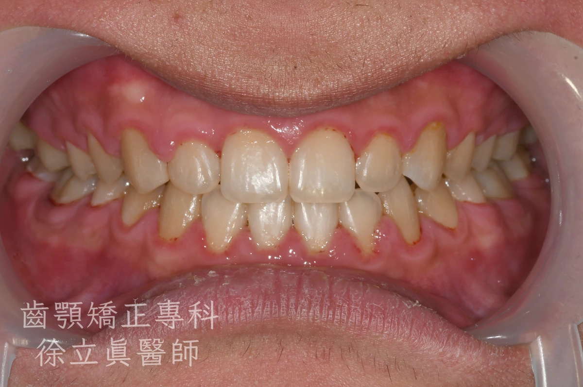案例三・正面・治療後