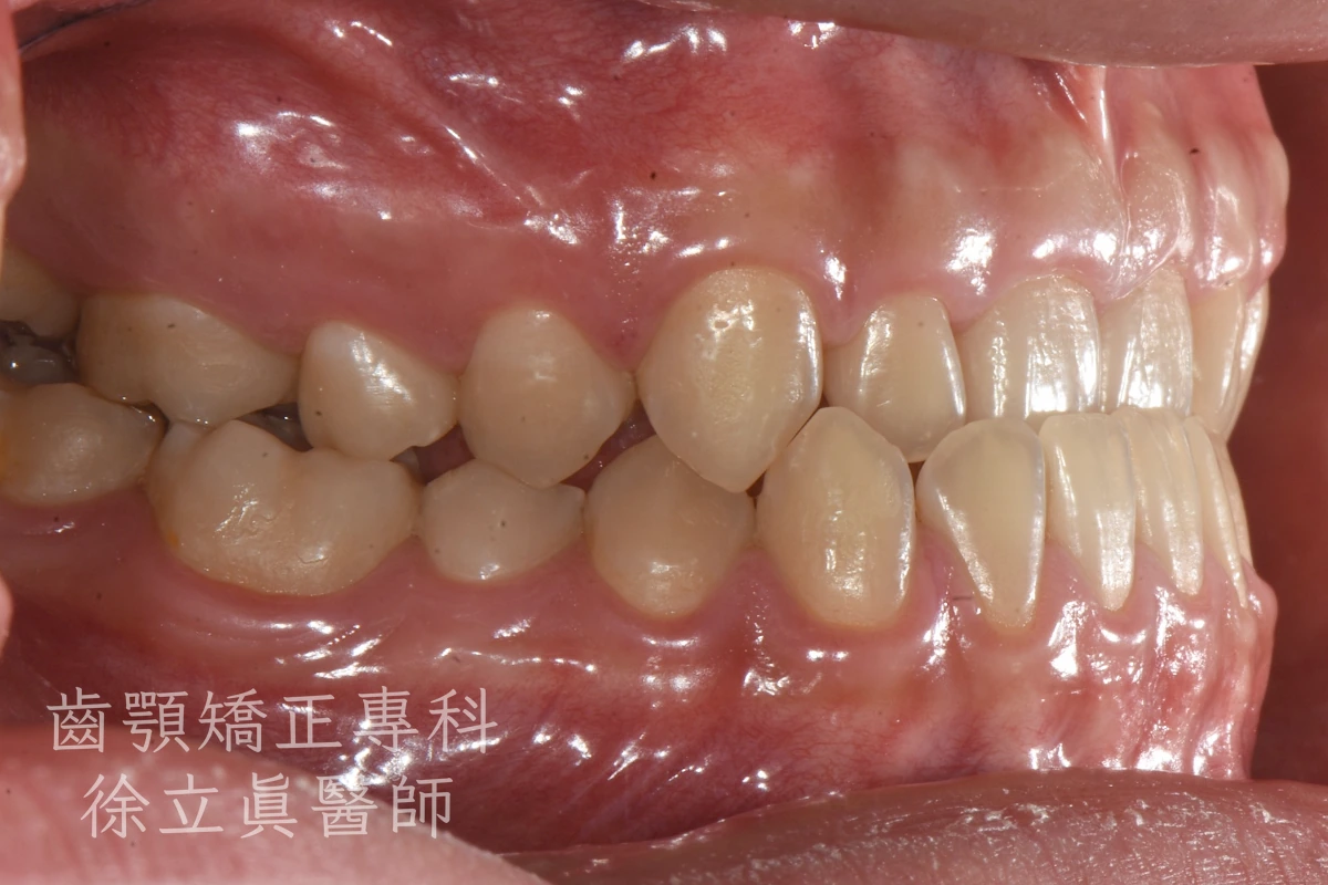 案例三・側面一・治療前