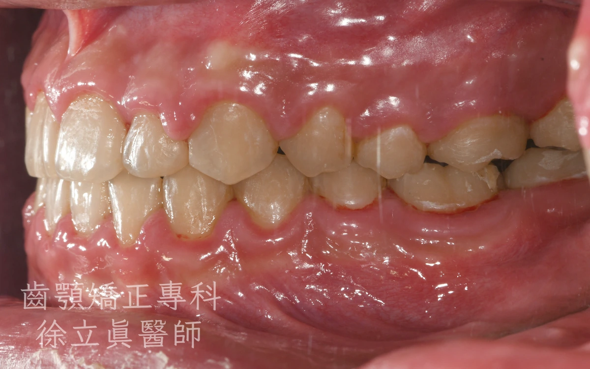 案例三・側面二・治療後