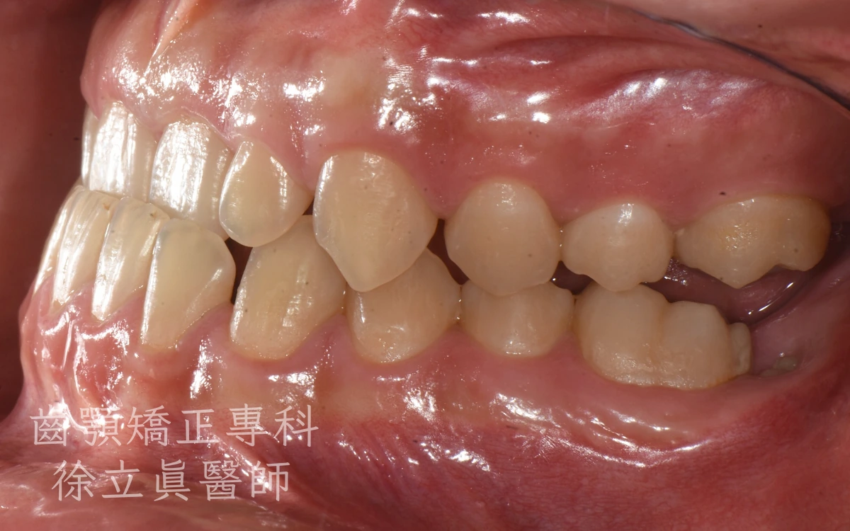 案例三・側面二・治療前